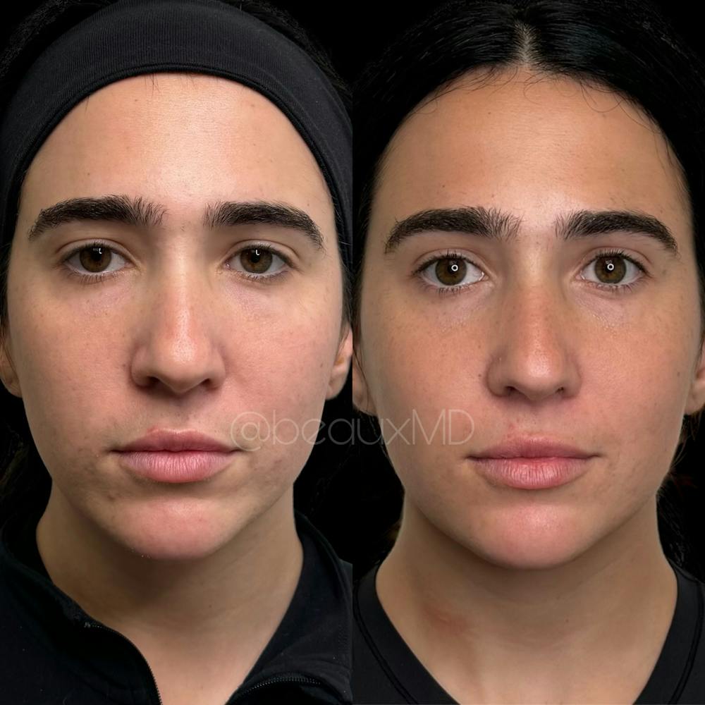 Dermal Fillers Before & After Gallery - Patient 134773 - Image 1