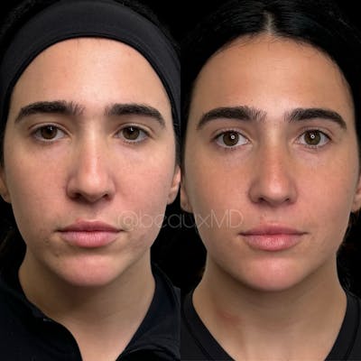 Dermal Fillers Before & After Gallery - Patient 134773 - Image 1