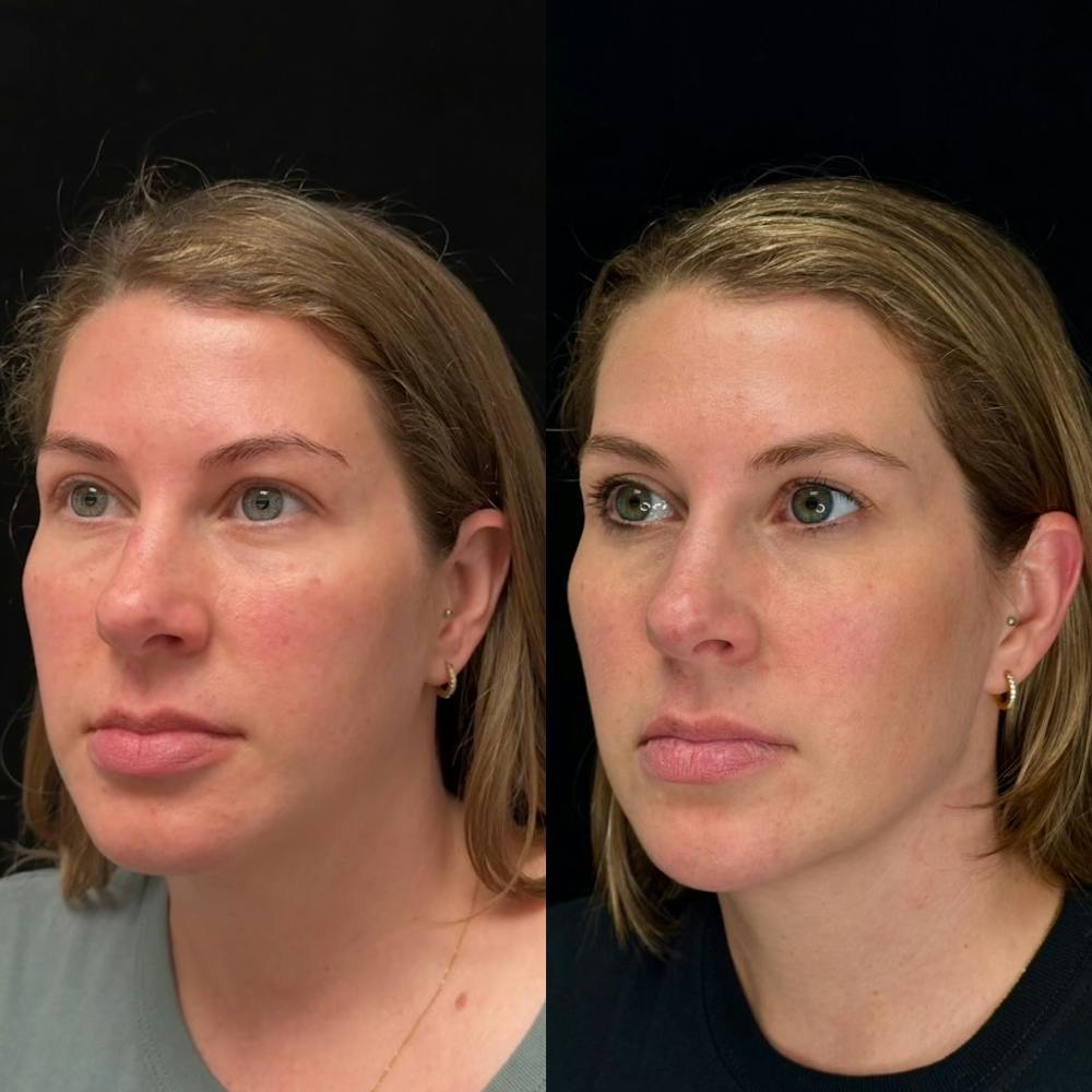 Dermal Fillers Before & After Gallery - Patient 669313 - Image 1