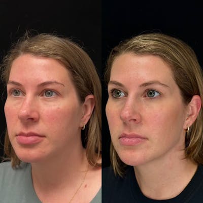 Dermal Fillers Before & After Gallery - Patient 669313 - Image 1