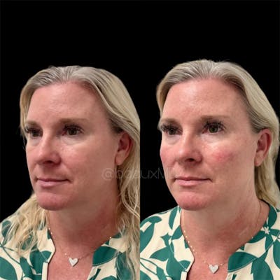Dermal Fillers Before & After Gallery - Patient 258327 - Image 1