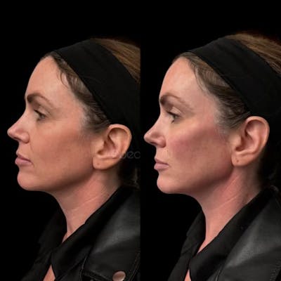 Dermal Fillers Before & After Gallery - Patient 129985 - Image 1