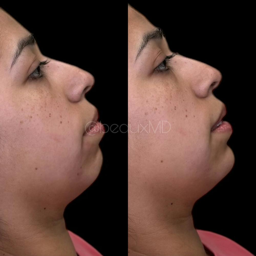 Dermal Fillers Before & After Gallery - Patient 175354 - Image 1