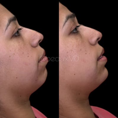 Dermal Fillers Before & After Gallery - Patient 175354 - Image 1
