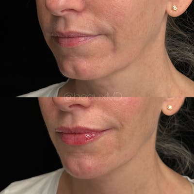 Dermal Fillers Before & After Gallery - Patient 171330 - Image 1