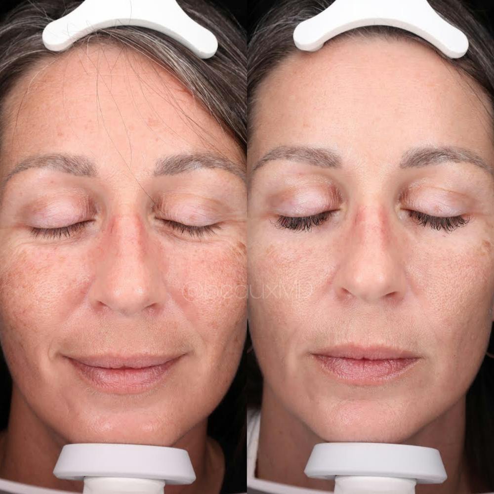 Laser Skin Resurfacing Before & After Gallery - Patient 481543 - Image 1