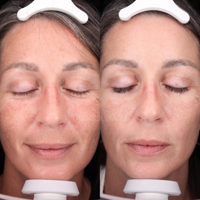 Laser Skin Resurfacing Before & After Gallery - Patient 481543 - Image 1