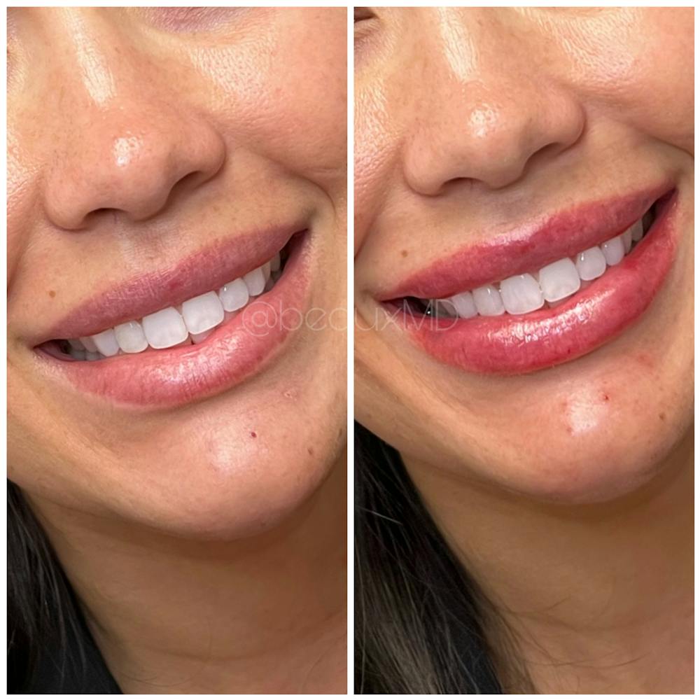 Lip Fillers Before & After Gallery - Patient 378716 - Image 1