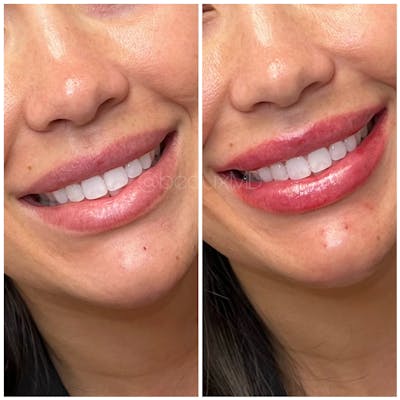 Lip Fillers Before & After Gallery - Patient 378716 - Image 1