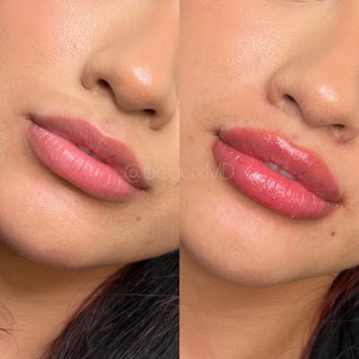 Lip Fillers Before & After Gallery - Patient 255067 - Image 1
