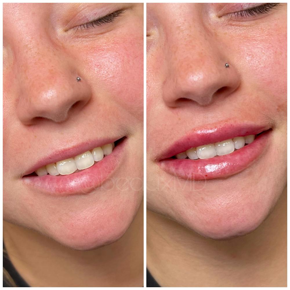 Lip Fillers Before & After Gallery - Patient 112188 - Image 1
