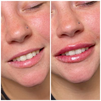 Lip Fillers Before & After Gallery - Patient 112188 - Image 1