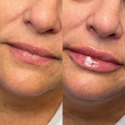 Lip Fillers Before & After Gallery - Patient 285116 - Image 1