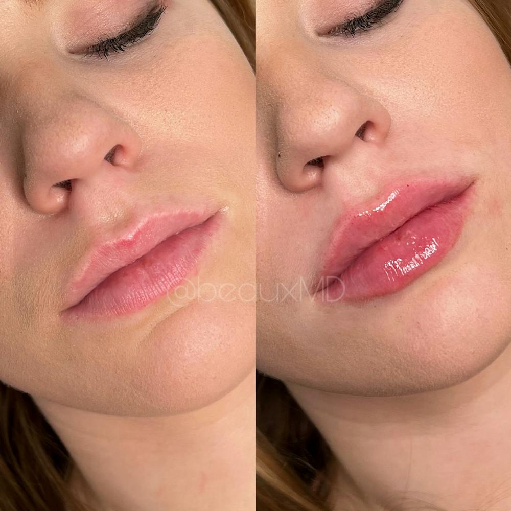 Lip Fillers Before & After Gallery - Patient 350712 - Image 1