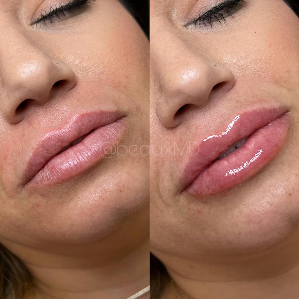Lip Fillers Before & After Gallery - Patient 130863 - Image 1