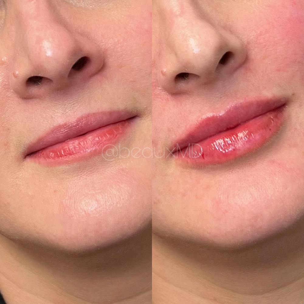 Lip Fillers Before & After Gallery - Patient 356632 - Image 1