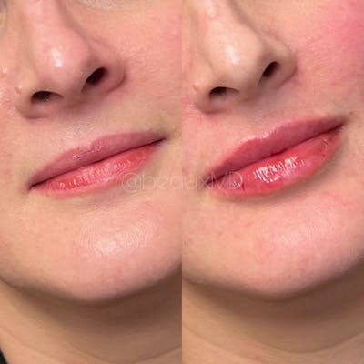 Lip Fillers Before & After Gallery - Patient 356632 - Image 1