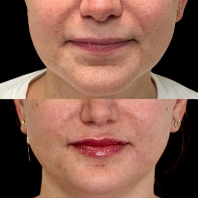 Lip Fillers Before & After Gallery - Patient 236429 - Image 1