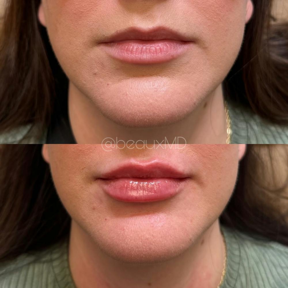 Lip Fillers Before & After Gallery - Patient 206835 - Image 1