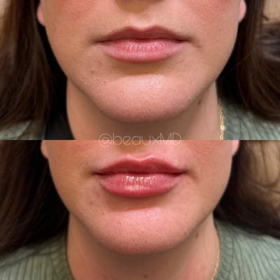 Lip Fillers Before & After Gallery - Patient 206835 - Image 1