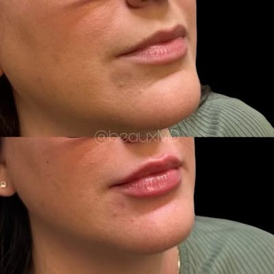 Lip Fillers Before & After Gallery - Patient 206835 - Image 2
