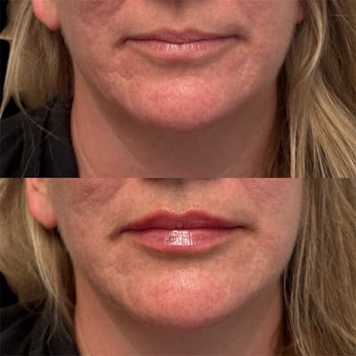 Lip Fillers Before & After Gallery - Patient 412453 - Image 1