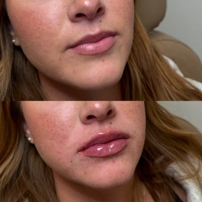 Lip Fillers Before & After Gallery - Patient 322605 - Image 1