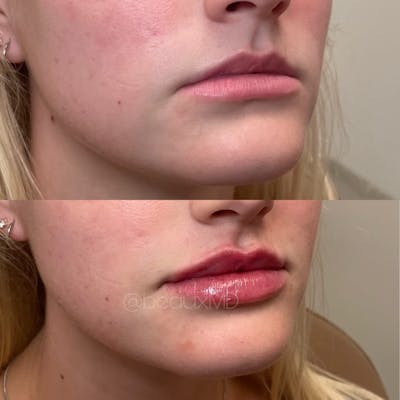 Lip Fillers Before & After Gallery - Patient 215674 - Image 1