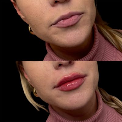 Lip Fillers Before & After Gallery - Patient 189610 - Image 1