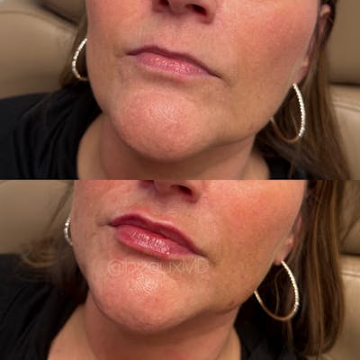 Lip Fillers Before & After Gallery - Patient 357228 - Image 1
