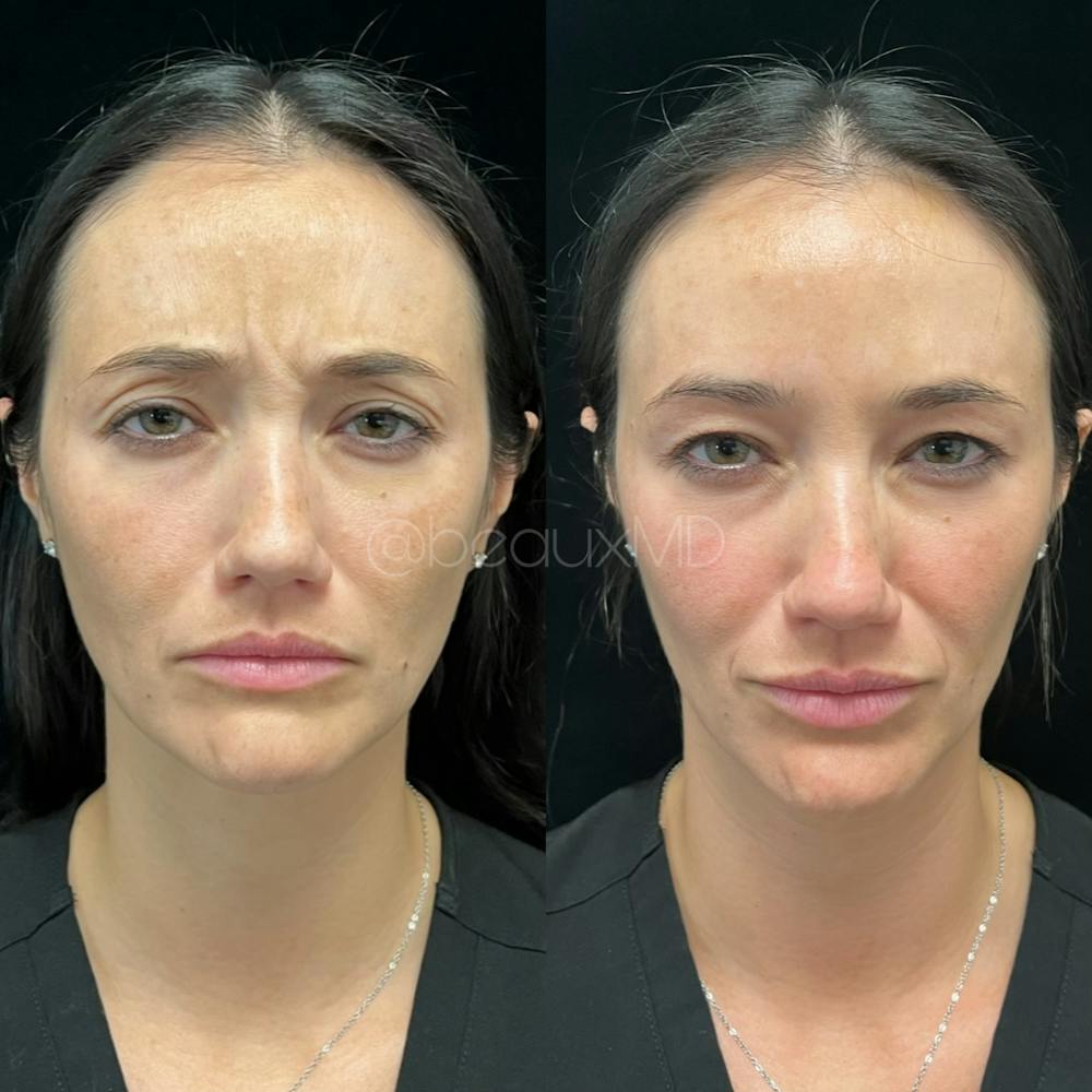 Neuromodulators Before & After Gallery - Patient 183593 - Image 1