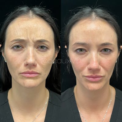 Neuromodulators Before & After Gallery - Patient 183593 - Image 1