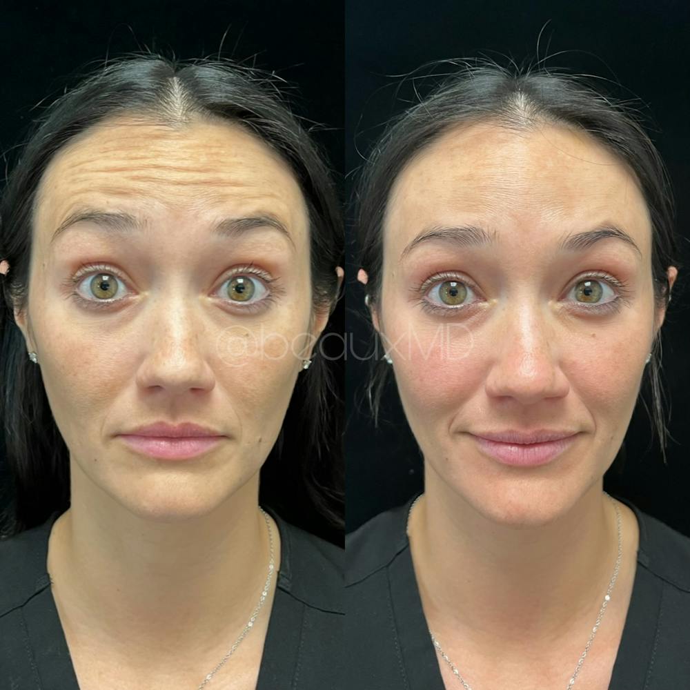 Neuromodulators Before & After Gallery - Patient 183593 - Image 2