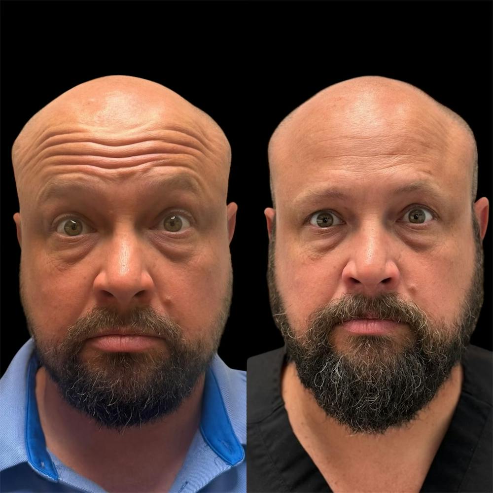 Neuromodulators Before & After Gallery - Patient 180917 - Image 2