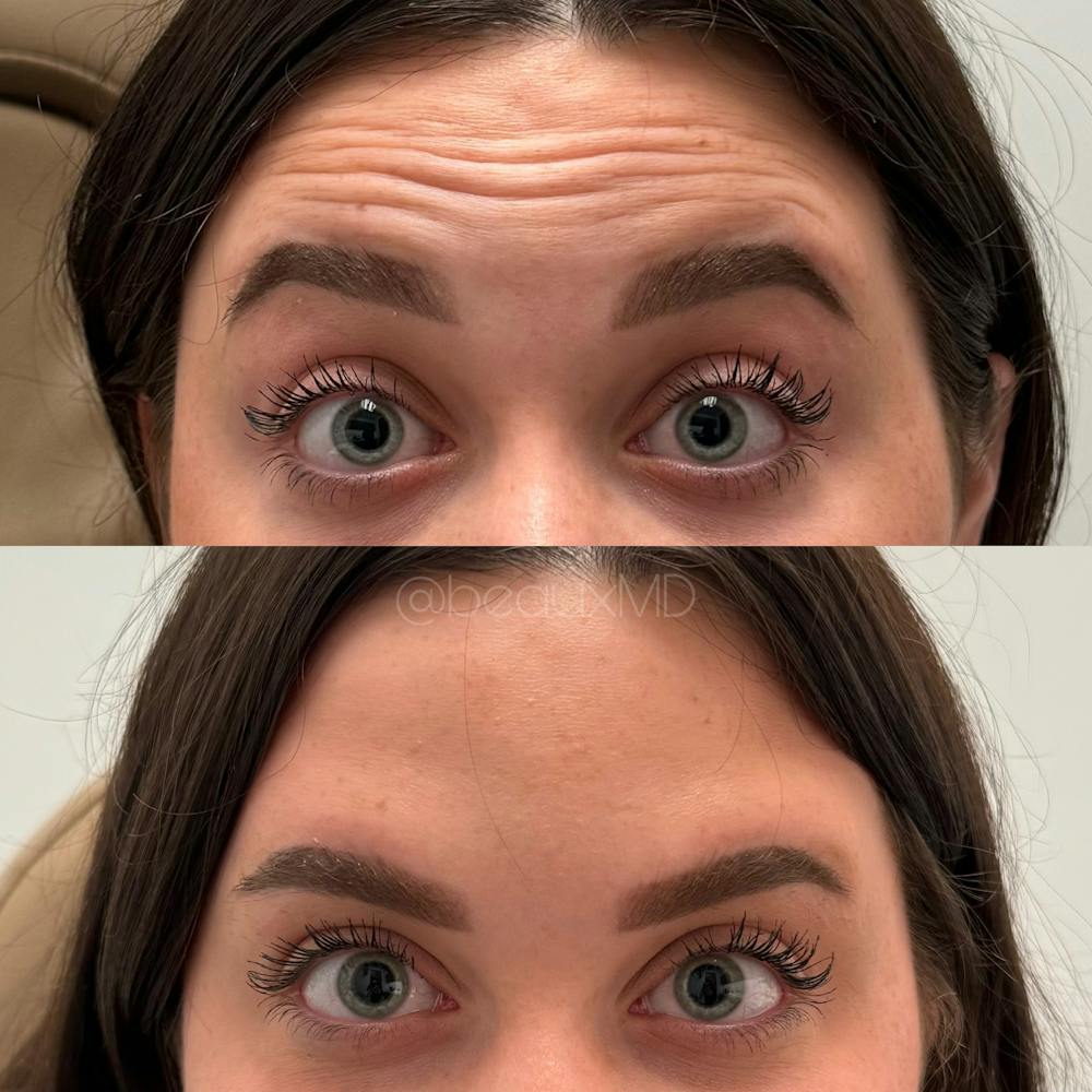 Neuromodulators Before & After Gallery - Patient 372526 - Image 1