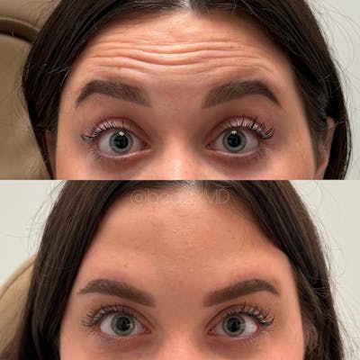 Neuromodulators Before & After Gallery - Patient 372526 - Image 1