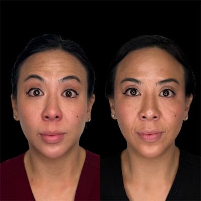 Neuromodulators Before & After Gallery - Patient 187462 - Image 1