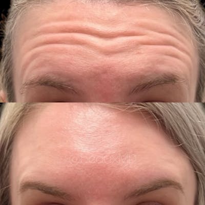 Neuromodulators Before & After Gallery - Patient 411302 - Image 1
