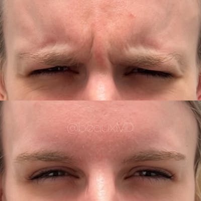 Neuromodulators Before & After Gallery - Patient 426912 - Image 1