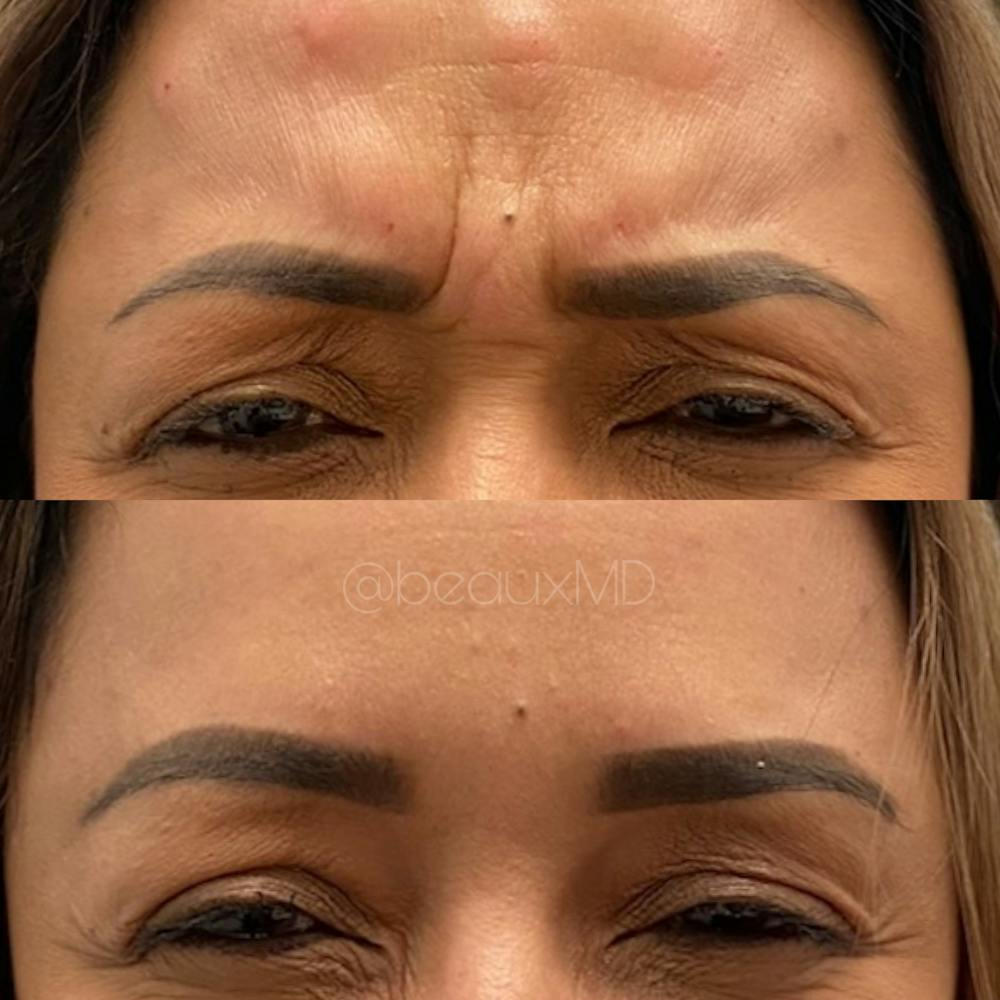 Neuromodulators Before & After Gallery - Patient 274769 - Image 1
