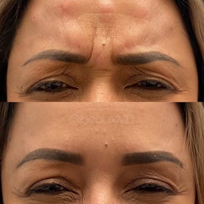 Neuromodulators Before & After Gallery - Patient 274769 - Image 1