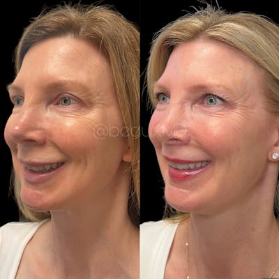 Sculptra Before & After Gallery - Patient 327347 - Image 1