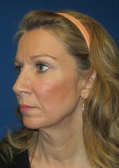 Facelift Before & After Gallery - Patient 226160 - Image 1