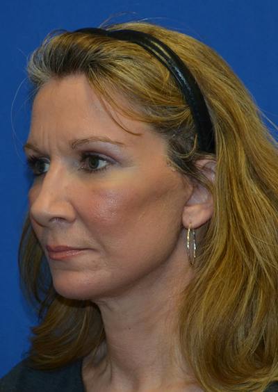 Facelift Before & After Gallery - Patient 226160 - Image 2