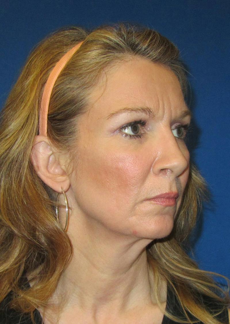 Facelift Before & After Gallery - Patient 226160 - Image 3