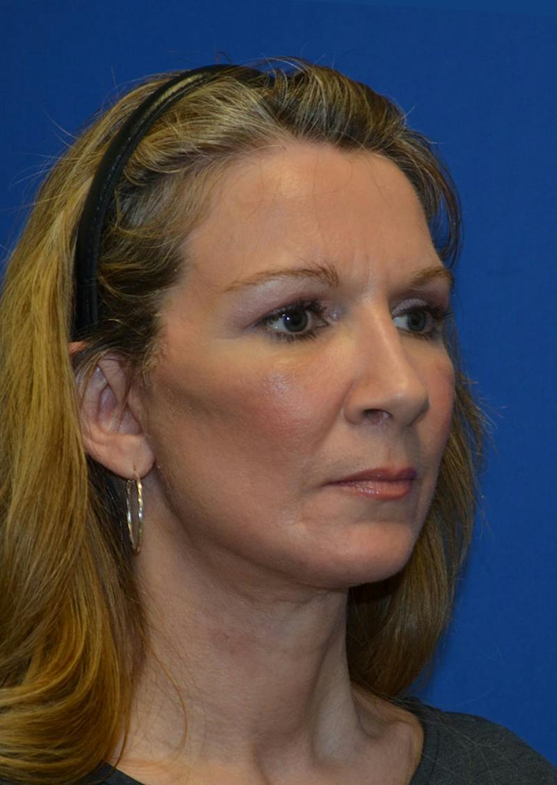 Facelift Before & After Gallery - Patient 226160 - Image 4