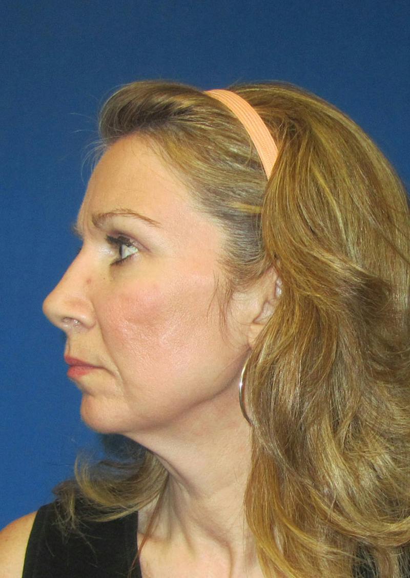 Facelift Before & After Gallery - Patient 226160 - Image 5