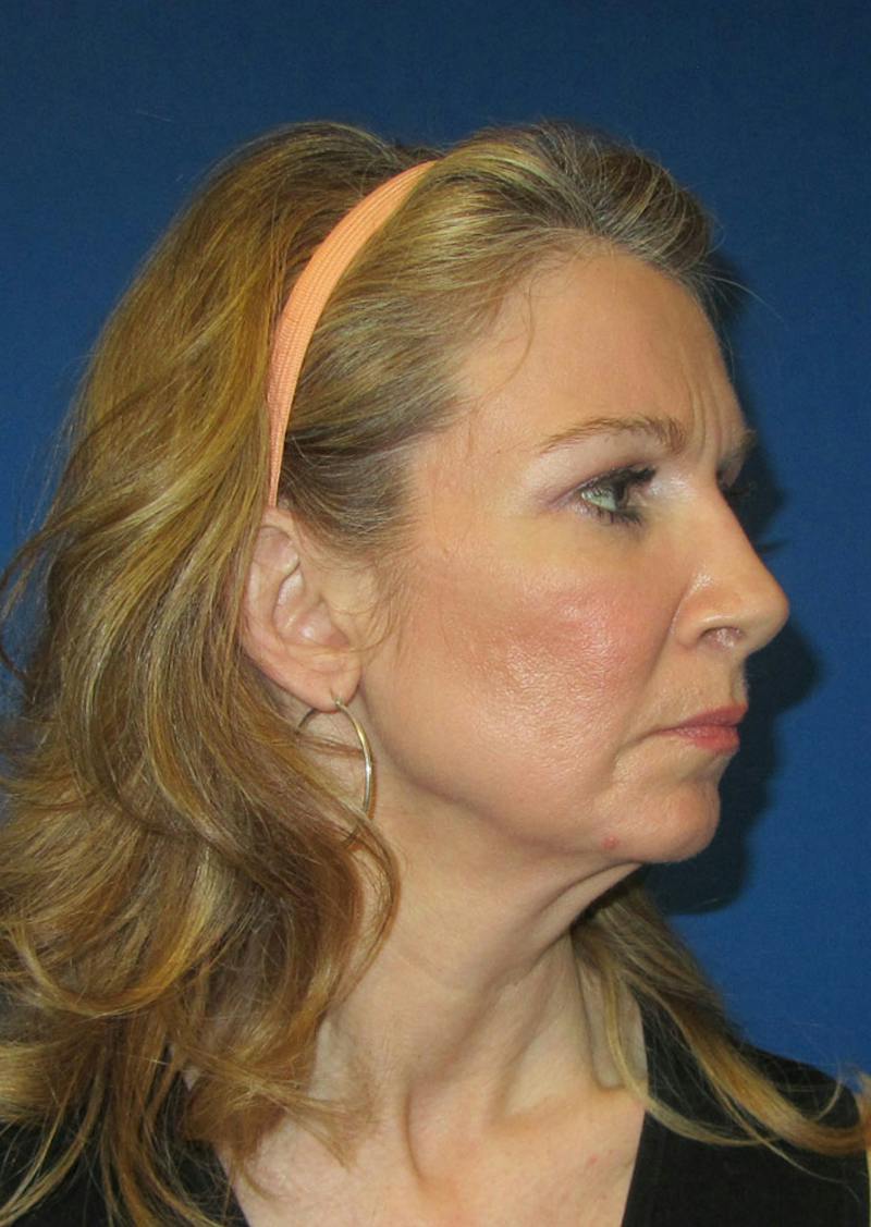 Facelift Before & After Gallery - Patient 226160 - Image 7