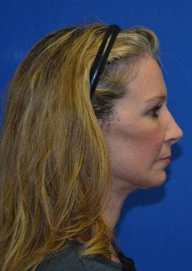 Facelift Before & After Gallery - Patient 226160 - Image 8