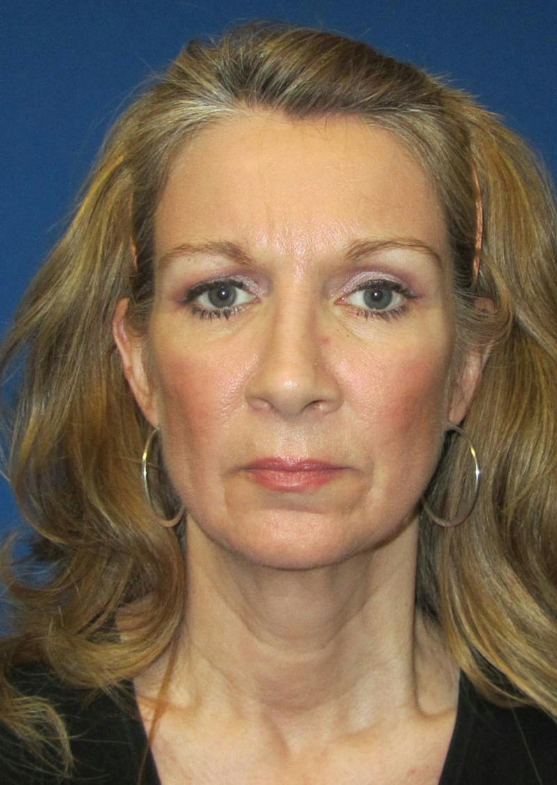 Facelift Before & After Gallery - Patient 226160 - Image 9